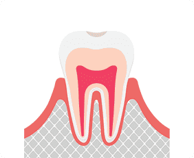 むし歯の前兆