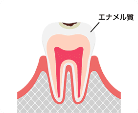 軽度のむし歯