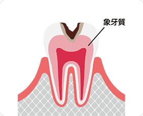 中度のむし歯