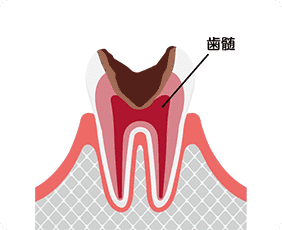 重度のむし歯