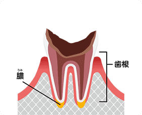 最重度のむし歯