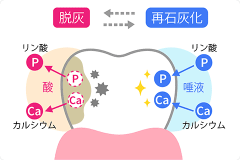 初期むし歯は再石灰化で修復