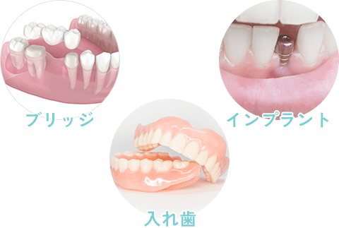 歯を失った場合の補綴治療のひとつ