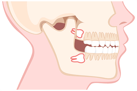 親知らずの抜歯